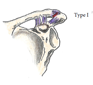 AC Joint Injuries