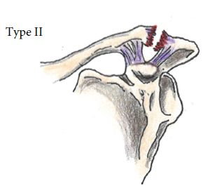 AC Joint Injuries