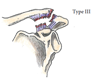 AC Joint Injuries