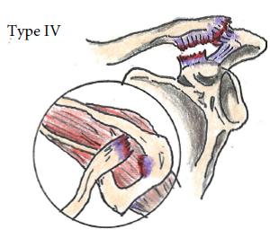 AC Joint Injuries