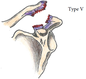 AC Joint Injuries