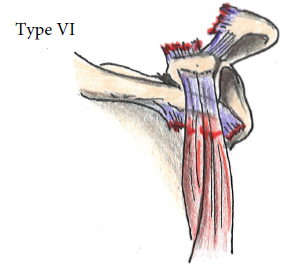 AC Joint Injuries