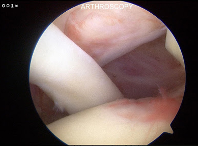 Arthroscopic image