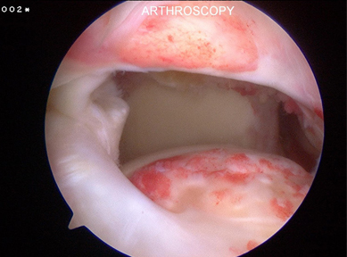 Arthroscopic image