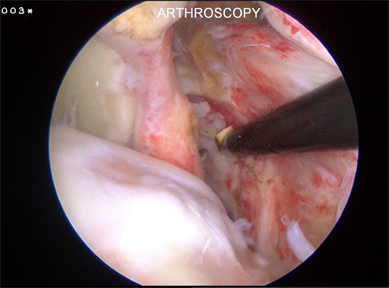 Arthroscopic image