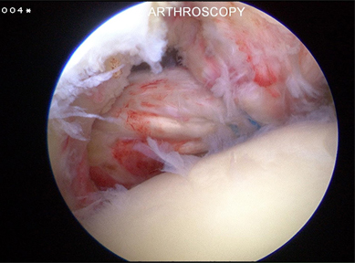 Arthroscopic image