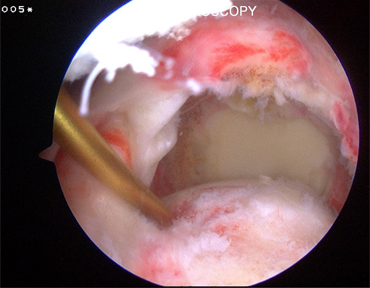 Arthroscopic image