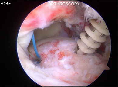 Arthroscopic image