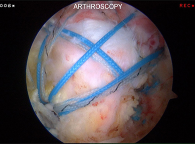 Arthroscopic image