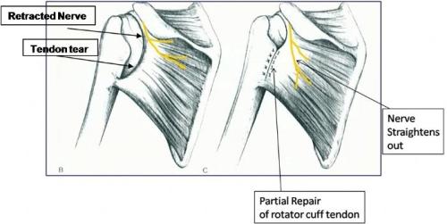 Arthroscopic Suprascapular Nerve Release