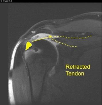 Irreparable Rotator Cuff Tear