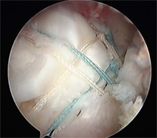 Rotator Cuff Tear After Treatment