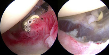 ARTHROSCOPIC CAPSULAR RELEASE