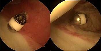 ARTHROSCOPIC CAPSULAR RELEASE