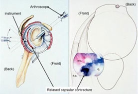 ARTHROSCOPIC CAPSULAR RELEASE