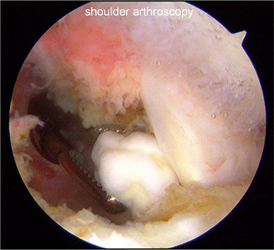 Arthroscopic Osteocapsular Arthroplasty