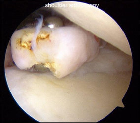 Arthroscopic Osteocapsular Arthroplasty