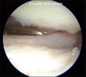 Arthroscopic Osteocapsular Arthroplasty