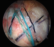 Shoulder Arthroscopic Procedure