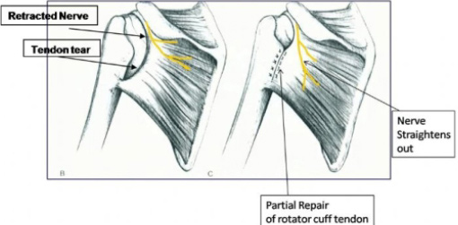 Arthroscopic Suprascapular Nerve Release