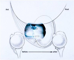 Arthroscopic Surgery