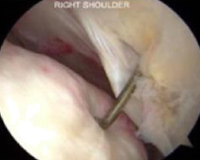 arthroscopic surgery