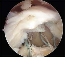 Rotator Cuff Tear Before Treatment