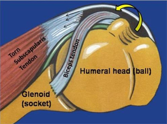 Biceps tendon subluxation