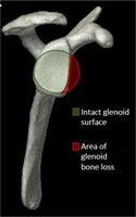 Bony injury