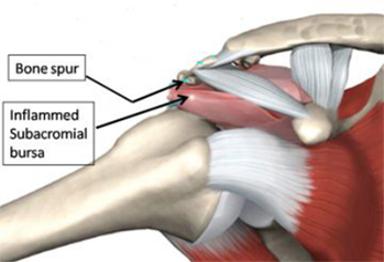 Impingement