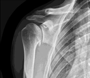 Shoulder Arthroscopic Procedure