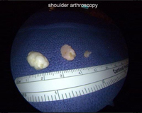 Shoulder Arthroscopic Procedure
