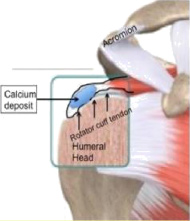 Calcific Tendonitis