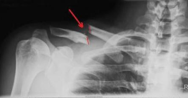 Clavicle Fractures