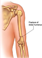 Distal Humerus Fracture