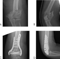 Distal Humerus Fracture