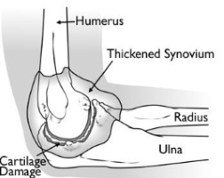 Elbow Replacement