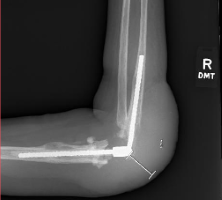 Treatment of complications following replacements