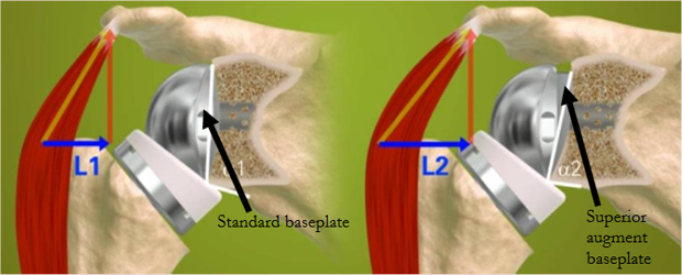 Equinoxe Reverse System