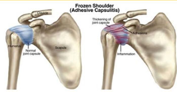 Frozen Shoulder