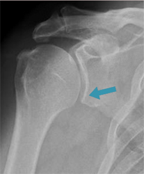 Glenoid Dysplasia