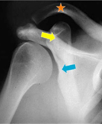 Glenoid Dysplasia