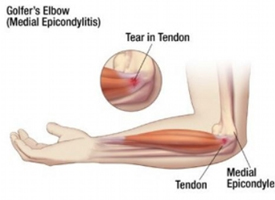 Golfer’s Elbow