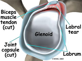 Labral Tears