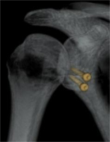 Latarjet procedure