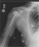 Shoulder Infection Operative Treatment