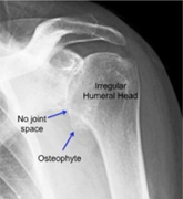 Osteoarthritis