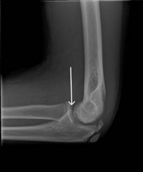 Osteochondritis dissecans treatment