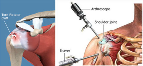 Rotator Cuff Tear Treatment