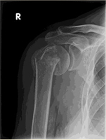 Proximal Humerus Fracture